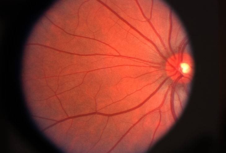 abnormal retina